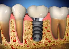 implant-crn