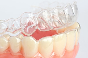 charlotte invisalign invisalignpic1