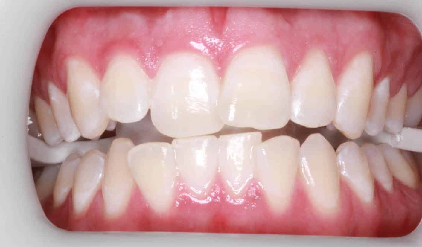Charlotte teeth whitening