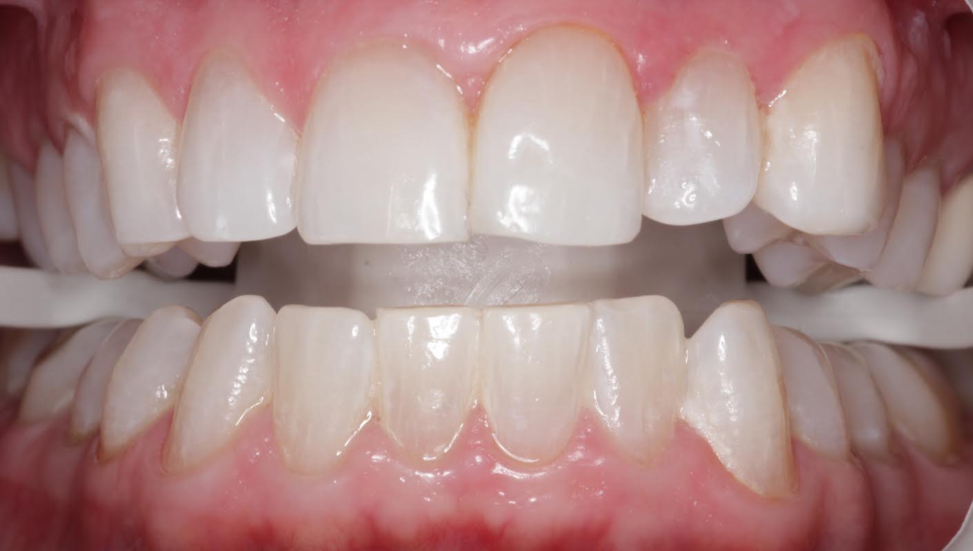 World-class teeth whitening in Charlotte