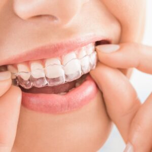 Woman putting in her invisalign