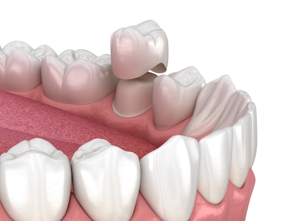 Dental Crowns Charlotte